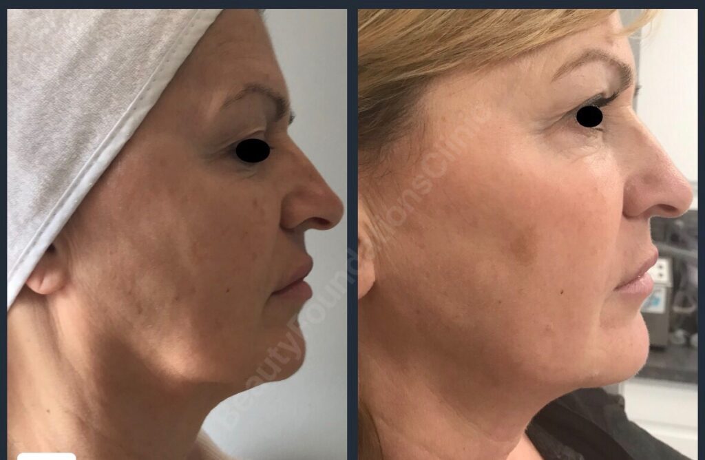 Sublative Rejuvenation