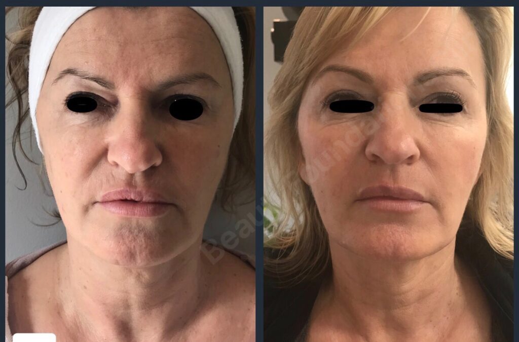 Sublative Rejuvenation